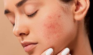 Tại Sao Uống Nước Cốt Nhàu Bị Ngứa, Nổi Mụn? Nguyên Nhân Và Cách Xử Lý
