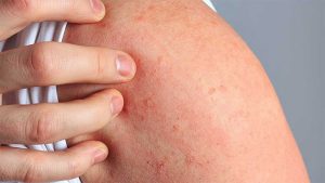 Tại Sao Uống Nước Cốt Nhàu Bị Ngứa, Nổi Mụn? Nguyên Nhân Và Cách Xử Lý